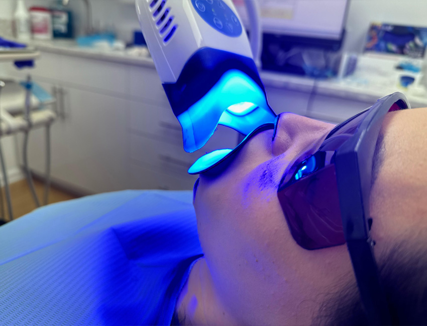 BaySmiles Dental | Dental Sealants, Preventative Program and Inlays amp Onlays